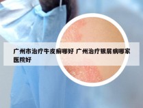 广州市治疗牛皮癣哪好 广州治疗银屑病哪家医院好