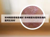 郑州哪里看银屑病好 郑州哪里有看银屑病的医院比较好