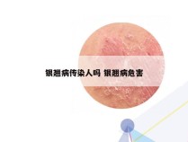 银翘病传染人吗 银翘病危害