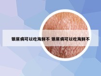 银屑病可以吃海鲜不 银屑病可以吃海鲜不