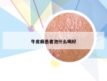 牛皮癣患者泡什么喝好