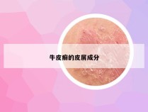 牛皮癣的皮屑成分