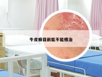 牛皮癣目前能不能根治