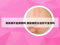 银屑病不能断根吗 银屑病可以治好不复发吗