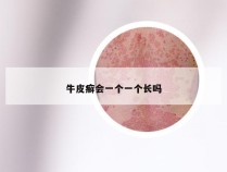 牛皮癣会一个一个长吗