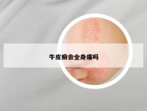 牛皮癣会全身痛吗