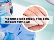 牛皮癣用糖皮质激素会复发吗 牛皮癣用糖皮质激素会复发吗怎么治疗