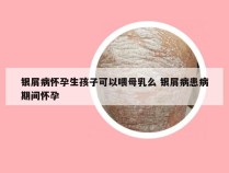 银屑病怀孕生孩子可以喂母乳么 银屑病患病期间怀孕
