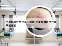 牛皮癣治疗中什么不能吃 牛皮癣治疗中什么不能吃的