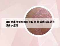 银屑病皮损处周围有小白点 银屑病皮损处有很多小疙瘩
