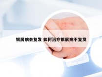 银屑病会复发 如何治疗银屑病不复发