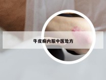 牛皮癣内服中医处方