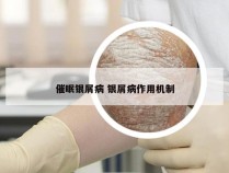 催眠银屑病 银屑病作用机制