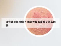 搞完外皮长皮癣了 搞完外皮长皮癣了怎么回事