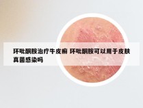环吡酮胺治疗牛皮癣 环吡酮胺可以用于皮肤真菌感染吗