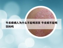 牛皮癣病人为什么不能喝浓茶 牛皮癣不能喝饮料吗