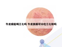 牛皮癣能喝三七吗 牛皮肤癣可以吃三七粉吗