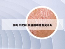 肺与牛皮癣 银屑病跟肺有关系吗