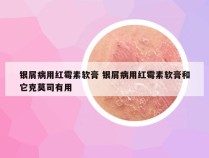 银屑病用红霉素软膏 银屑病用红霉素软膏和它克莫司有用