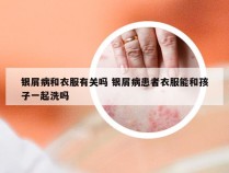 银屑病和衣服有关吗 银屑病患者衣服能和孩子一起洗吗