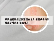银屑病初期症状资深西安北方 银屑病会传染给孩子吗采用 西安北方