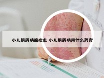 小儿银屑病能痊愈 小儿银屑病用什么药膏
