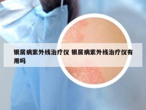 银屑病紫外线治疗仪 银屑病紫外线治疗仪有用吗