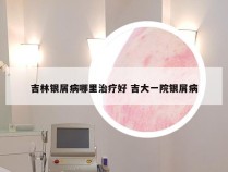 吉林银屑病哪里治疗好 吉大一院银屑病