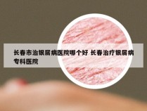 长春市治银屑病医院哪个好 长春治疗银屑病专科医院