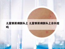 儿童银屑病额头上 儿童银屑病额头上会长痘吗