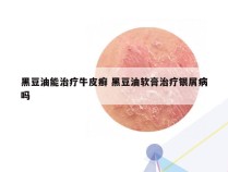 黑豆油能治疗牛皮癣 黑豆油软膏治疗银屑病吗