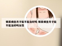 银屑病坐月子能不能治好吗 银屑病坐月子能不能治好吗女性