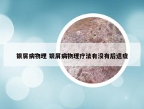银屑病物理 银屑病物理疗法有没有后遗症