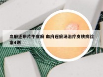 血府逐瘀片牛皮癣 血府逐瘀汤治疗皮肤病验案4则