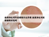血液净化对牛皮癣有什么作用 血液净化对皮肤病有好处吗