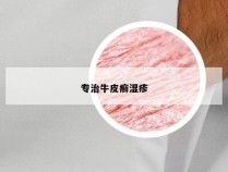 专治牛皮癣湿疹