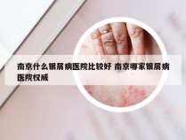 南京什么银屑病医院比较好 南京哪家银屑病医院权威
