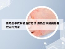 血热型牛皮癣的治疗方法 血热型银屑病最有效治疗方法