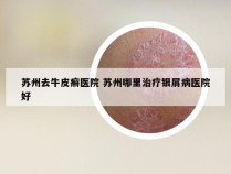 苏州去牛皮癣医院 苏州哪里治疗银屑病医院好