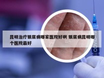 昆明治疗银屑病哪家医院好啊 银屑病昆明哪个医院最好
