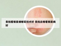 贵阳看银屑病哪家技术好 贵阳去哪看银屑病好
