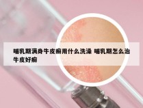 哺乳期满身牛皮癣用什么洗澡 哺乳期怎么治牛皮好癣