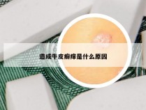 造成牛皮癣痒是什么原因