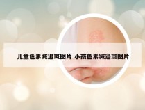 儿童色素减退斑图片 小孩色素减退斑图片
