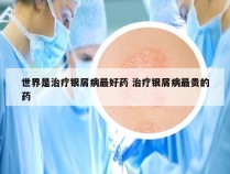 世界是治疗银屑病最好药 治疗银屑病最贵的药