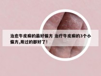 治愈牛皮癣的最好偏方 治疗牛皮癣的3个小偏方,用过的都好了!
