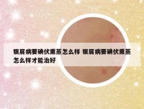 银屑病要碘伏熏蒸怎么样 银屑病要碘伏熏蒸怎么样才能治好