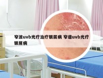 窄波uvb光疗治疗银屑病 窄谱uvb光疗银屑病