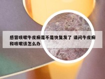 感冒咳嗽牛皮癣是不是快复发了 请问牛皮癣和咳嗽该怎么办