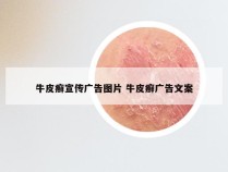 牛皮癣宣传广告图片 牛皮癣广告文案